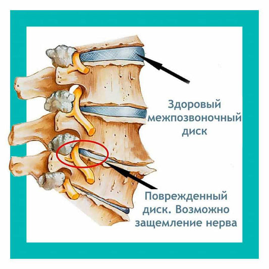 Чем опасно защемление позвоночного нерва? - sportprotection