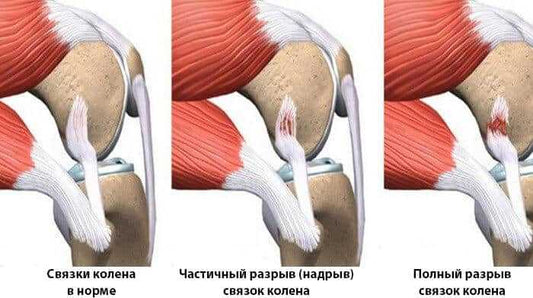 Опасность разрыва крестообразной связки и меры ее профилактики - sportprotection