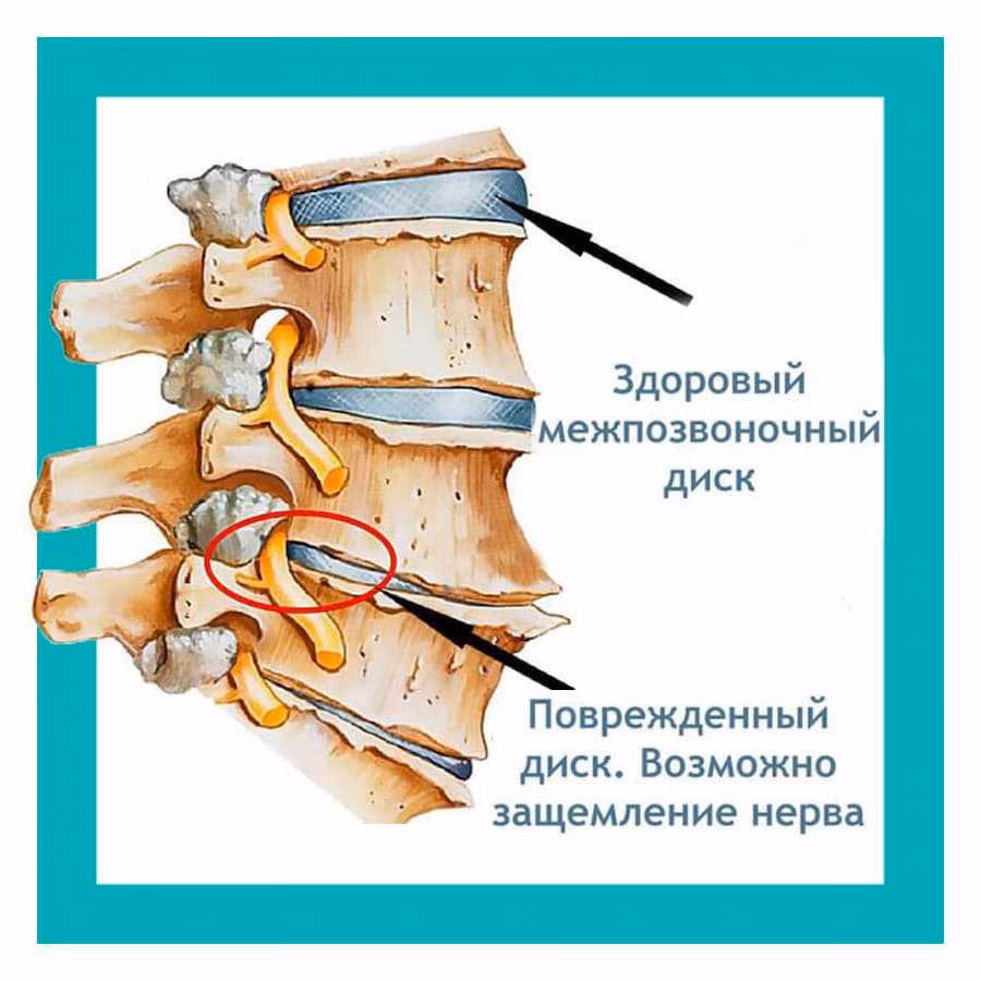 Чем опасно защемление позвоночного нерва?