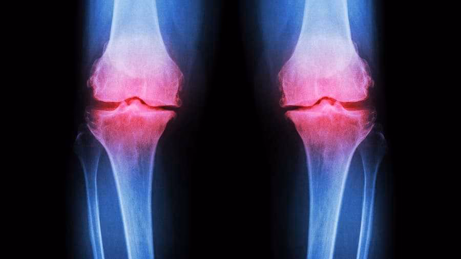 Как справиться с ревматоидным артритом колена когда лекарства не помогают?