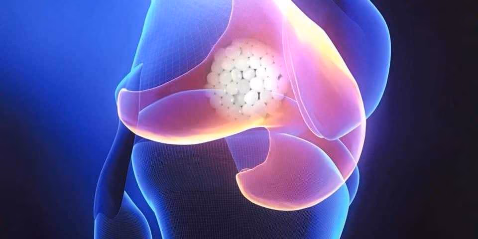 Как вылечить артроз коленного сустава без лекарств?