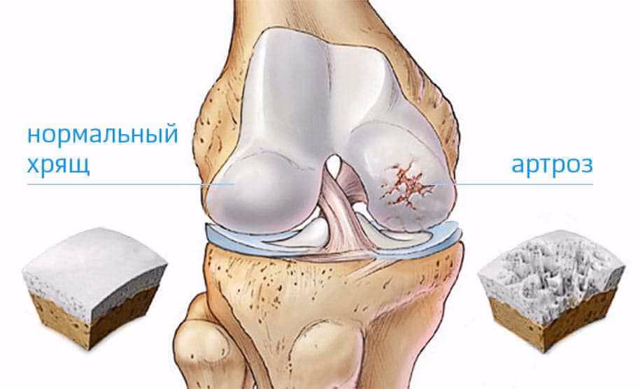 Наколенники при артрозе купить Киев